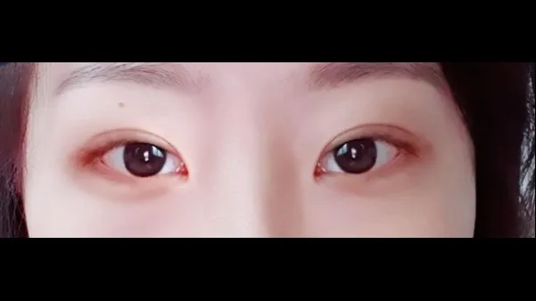 Partial Incision Double Eyelid Surgery, Ptosis Correction — RE&RE PLASTIC SURGERY 4
