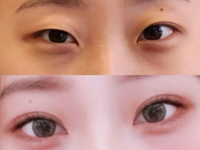 Partial Incision Double Eyelid Surgery, Ptosis Correction — RE&RE PLASTIC SURGERY 5