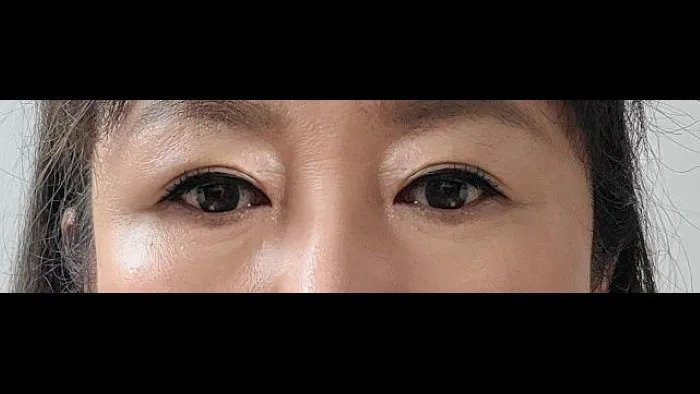 Sub-brow Lift — RE&RE PLASTIC SURGERY 3