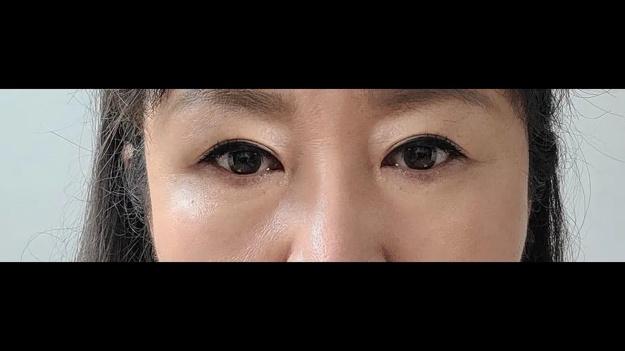 Sub-brow Lift — RE&RE PLASTIC SURGERY 4
