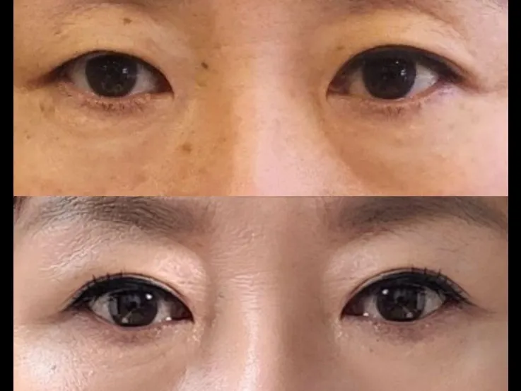 Sub-brow Lift — RE&RE PLASTIC SURGERY 5