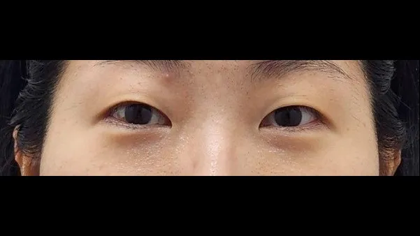 Incisional Double Eyelid Surgery, Ptosis Correction — RE&RE PLASTIC SURGERY 1
