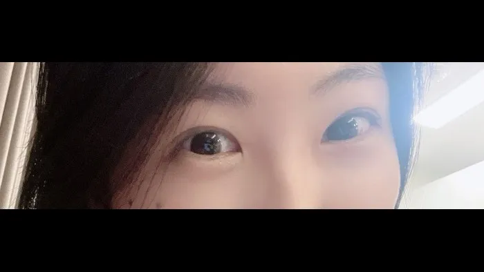 Incisional Double Eyelid Surgery, Ptosis Correction — RE&RE PLASTIC SURGERY 2