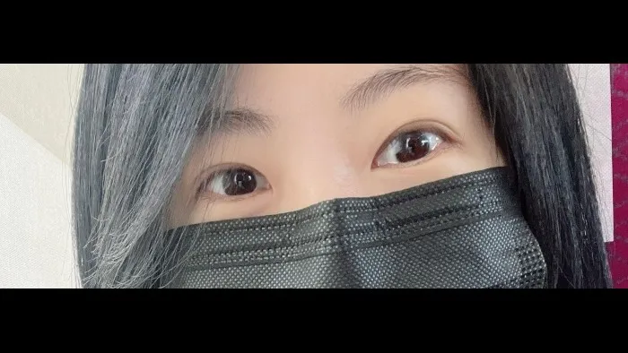 Incisional Double Eyelid Surgery, Ptosis Correction — RE&RE PLASTIC SURGERY 3