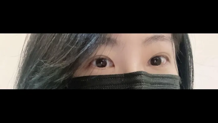 Incisional Double Eyelid Surgery, Ptosis Correction — RE&RE PLASTIC SURGERY 4