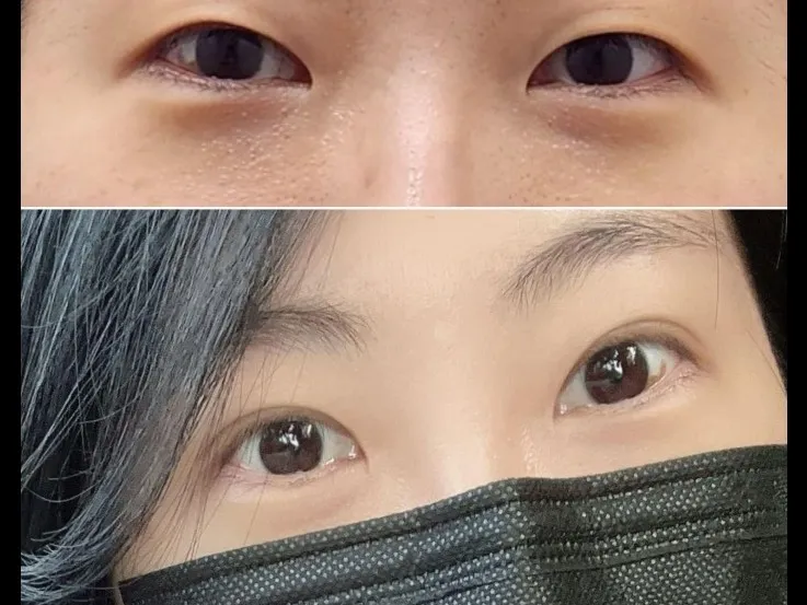Incisional Double Eyelid Surgery, Ptosis Correction — RE&RE PLASTIC SURGERY 5