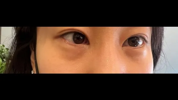 Lower Eyelid Fat Repositioning, Lower Eyelid Fat Grafting 1