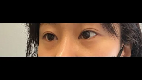 Lower Eyelid Fat Repositioning, Lower Eyelid Fat Grafting 2