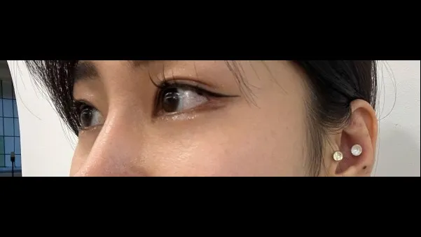 Lower Eyelid Fat Repositioning, Lower Eyelid Fat Grafting — RE&RE PLASTIC SURGERY 5