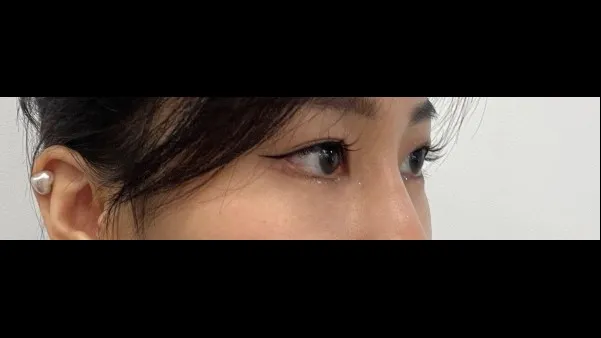Lower Eyelid Fat Repositioning, Lower Eyelid Fat Grafting — RE&RE PLASTIC SURGERY 6