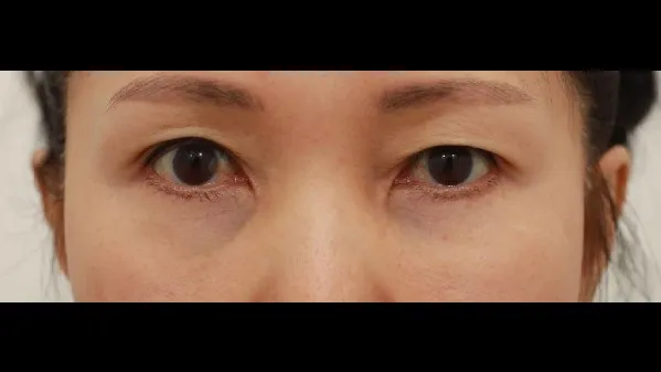 Sub-brow Lift, Lower Blepharoplasty (Aging Eye Rejuvenation), Lower Eyelid Fat Grafting, Midface Lift 1