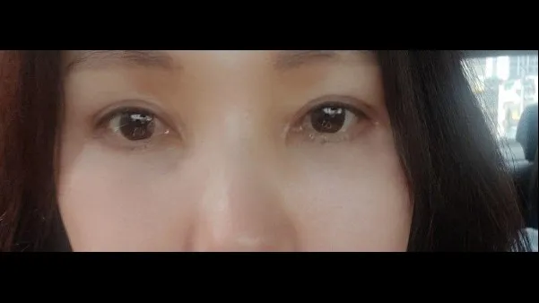 Sub-brow Lift, Lower Blepharoplasty (Aging Eye Rejuvenation), Lower Eyelid Fat Grafting, Midface Lift 2