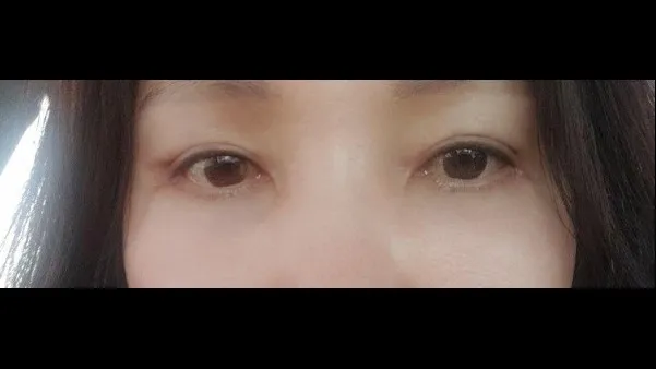 Sub-brow Lift, Lower Blepharoplasty (Aging Eye Rejuvenation), Lower Eyelid Fat Grafting, Midface Lift — RE&RE PLASTIC SURGERY 3