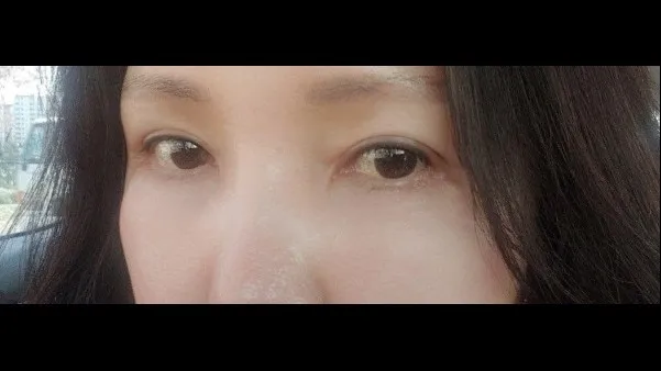 Sub-brow Lift, Lower Blepharoplasty (Aging Eye Rejuvenation), Lower Eyelid Fat Grafting, Midface Lift — RE&RE PLASTIC SURGERY 4