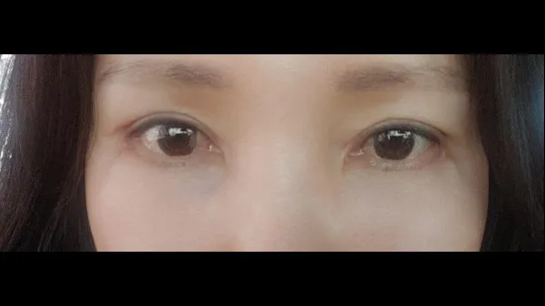 Sub-brow Lift, Lower Blepharoplasty (Aging Eye Rejuvenation), Lower Eyelid Fat Grafting, Midface Lift — RE&RE PLASTIC SURGERY 5