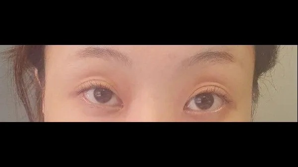 Partial Incision Double Eyelid Surgery, Lower Eyelid Fat Grafting 1