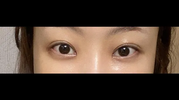 Partial Incision Double Eyelid Surgery, Lower Eyelid Fat Grafting 2