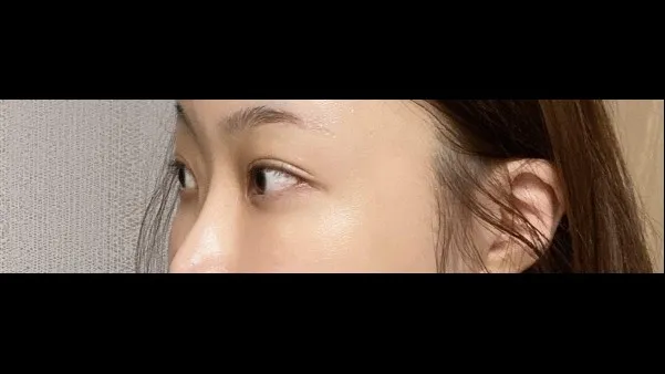 Partial Incision Double Eyelid Surgery, Lower Eyelid Fat Grafting — RE&RE PLASTIC SURGERY 4