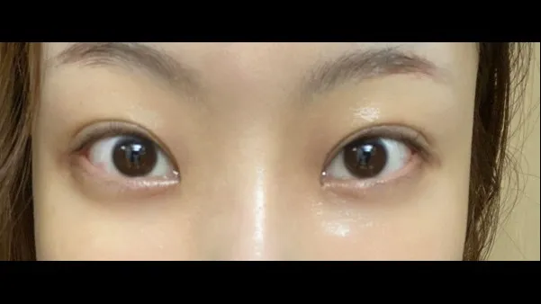 Partial Incision Double Eyelid Surgery, Lower Eyelid Fat Grafting — RE&RE PLASTIC SURGERY 5