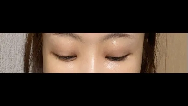 Partial Incision Double Eyelid Surgery, Lower Eyelid Fat Grafting — RE&RE PLASTIC SURGERY 6
