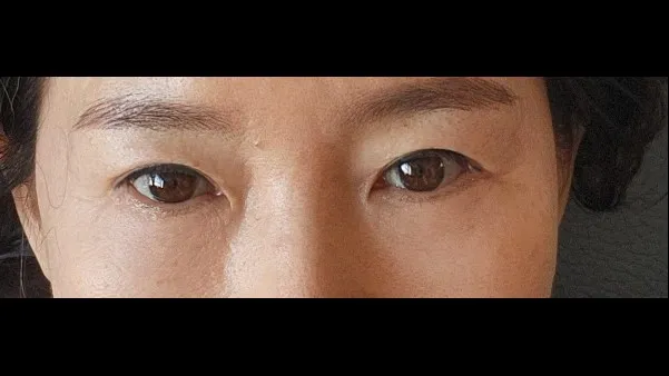 Sub-brow Lift, Lower Blepharoplasty (Aging Eye Rejuvenation) — RE&RE PLASTIC SURGERY 2