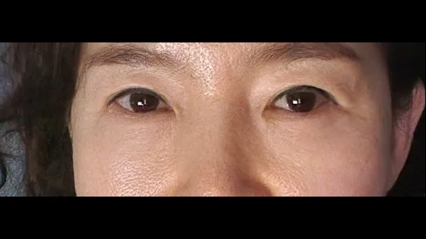 Sub-brow Lift, Lower Blepharoplasty (Aging Eye Rejuvenation) — RE&RE PLASTIC SURGERY 3