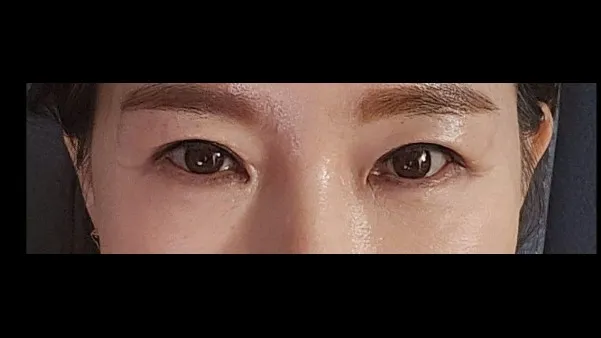 Sub-brow Lift, Lower Blepharoplasty (Aging Eye Rejuvenation) — RE&RE PLASTIC SURGERY 4
