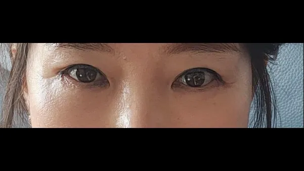 Sub-brow Lift, Lower Blepharoplasty (Aging Eye Rejuvenation) — RE&RE PLASTIC SURGERY 5
