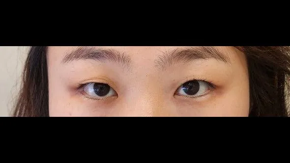 Partial Incision Double Eyelid Surgery, Ptosis Correction 1