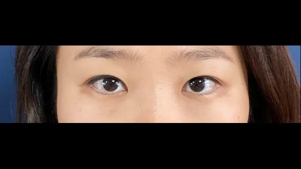 Partial Incision Double Eyelid Surgery, Ptosis Correction 2
