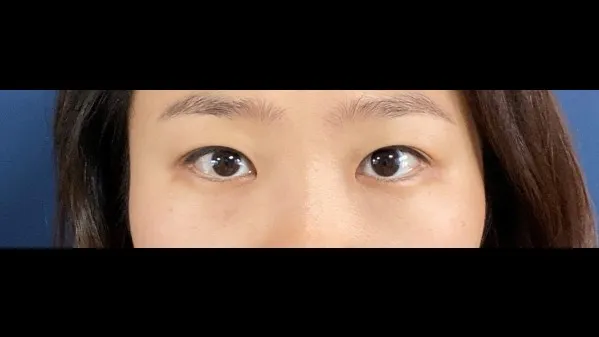 Partial Incision Double Eyelid Surgery, Ptosis Correction — RE&RE PLASTIC SURGERY 3