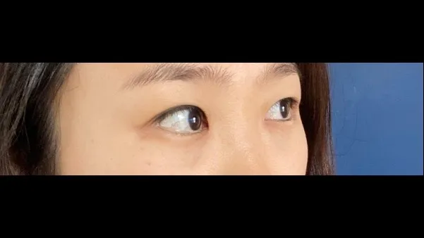 Partial Incision Double Eyelid Surgery, Ptosis Correction — RE&RE PLASTIC SURGERY 4