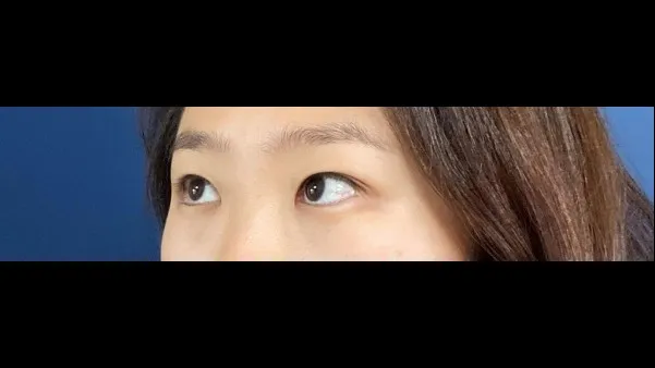 Partial Incision Double Eyelid Surgery, Ptosis Correction — RE&RE PLASTIC SURGERY 5