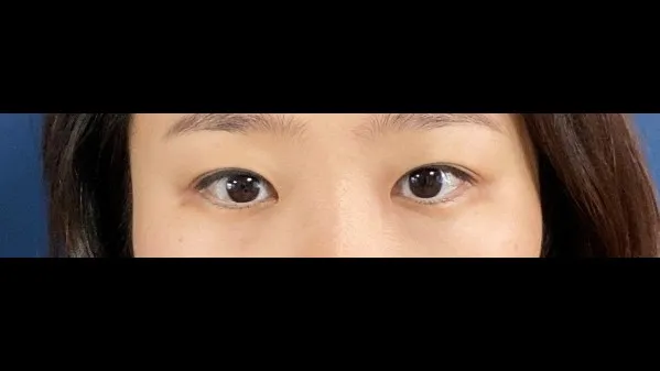 Partial Incision Double Eyelid Surgery, Ptosis Correction — RE&RE PLASTIC SURGERY 6