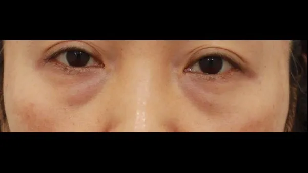 下眼瞼形成(中高年の目元) — RE&RE PLASTIC SURGERY 1