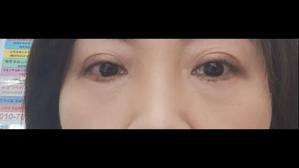 下眼瞼形成（中高年の目元） 2