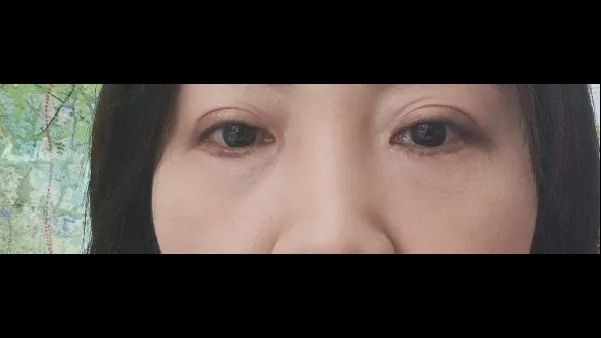 下眼瞼形成(中高年の目元) — RE&RE PLASTIC SURGERY 3