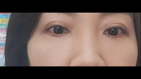 下眼瞼形成(中高年の目元) — RE&RE PLASTIC SURGERY 4
