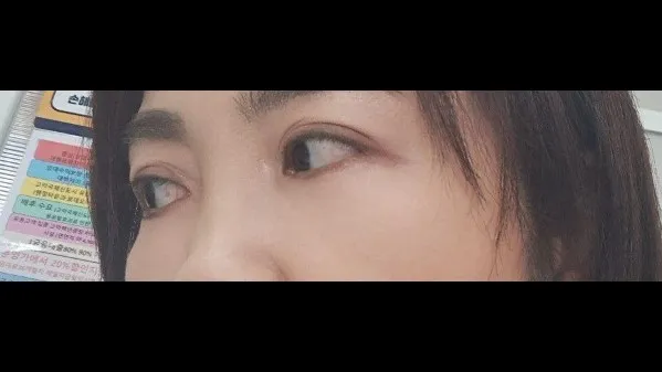 下眼瞼形成(中高年の目元) — RE&RE PLASTIC SURGERY 5