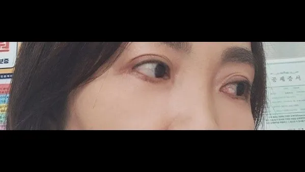 下眼瞼形成(中高年の目元) — RE&RE PLASTIC SURGERY 6