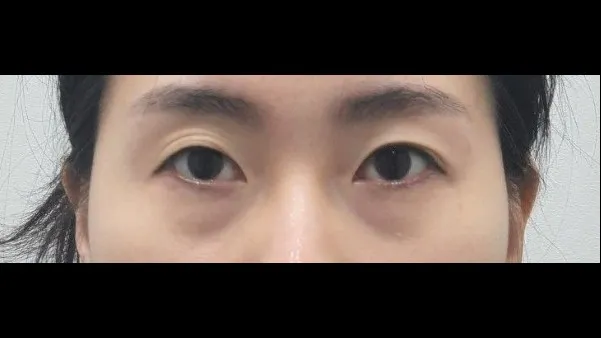Incisional Double Eyelid Surgery, Ptosis Correction, Lower Eyelid Fat Repositioning, Lower Eyelid Fat Grafting 1
