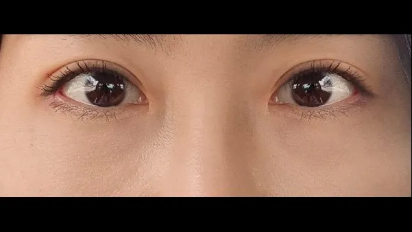 Incisional Double Eyelid Surgery, Ptosis Correction, Lower Eyelid Fat Repositioning, Lower Eyelid Fat Grafting 2