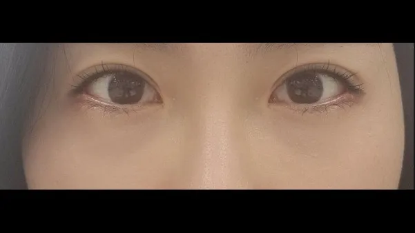 切開法(二重), 目つき矯正, 目の下脂肪再配置, 目の下脂肪移植 — RE&RE PLASTIC SURGERY 3