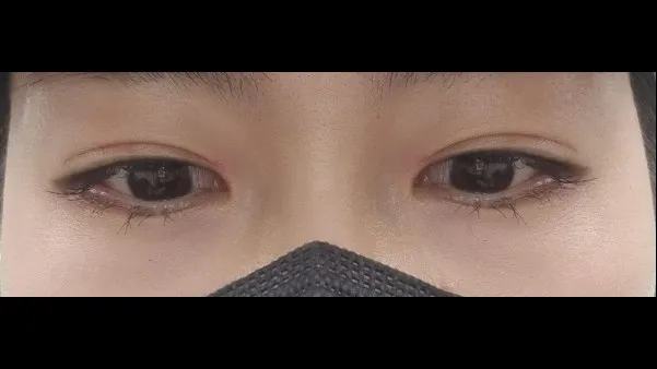 切開法(二重), 目つき矯正, 目の下脂肪再配置, 目の下脂肪移植 — RE&RE PLASTIC SURGERY 4
