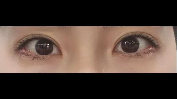 切開法(二重), 目つき矯正, 目の下脂肪再配置, 目の下脂肪移植 — RE&RE PLASTIC SURGERY 5