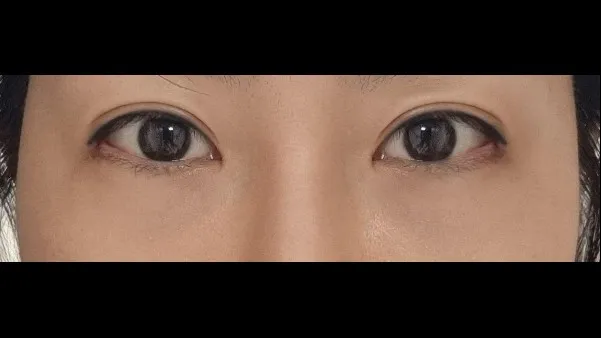 切開法(二重), 目つき矯正, 目の下脂肪再配置, 目の下脂肪移植 — RE&RE PLASTIC SURGERY 6