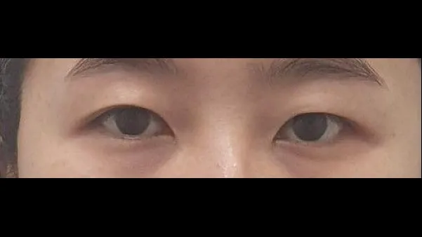 Natural Adhesion Double Eyelid Surgery, Ptosis Correction 1