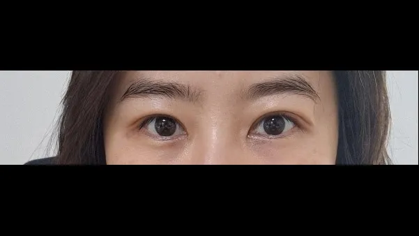 自然癒着法, 目つき矯正 — RE&RE PLASTIC SURGERY 2