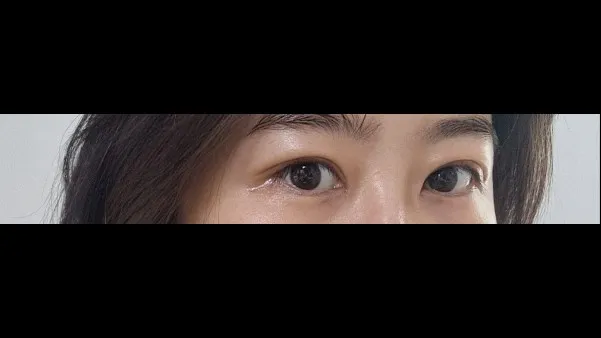 自然癒着法, 目つき矯正 — RE&RE PLASTIC SURGERY 3