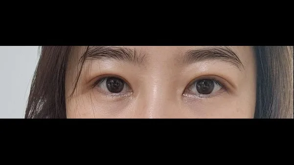 自然癒着法, 目つき矯正 — RE&RE PLASTIC SURGERY 5